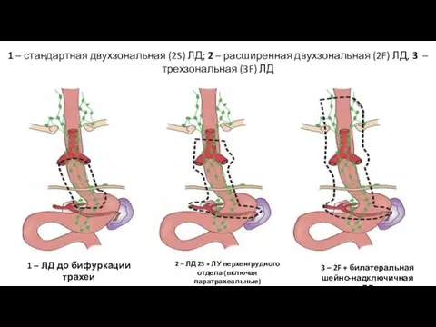 1 – стандартная двухзональная (2S) ЛД; 2 – расширенная двухзональная (2F)