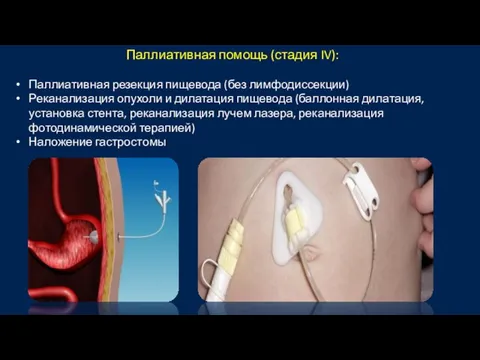 Паллиативная помощь (стадия IV): Паллиативная резекция пищевода (без лимфодиссекции) Реканализация опухоли