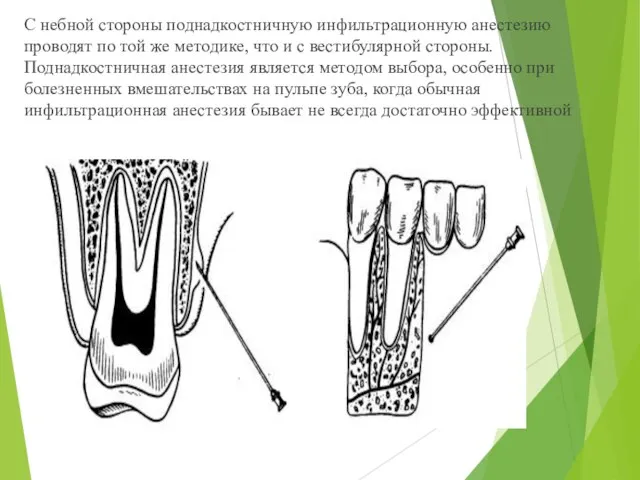 С небной стороны поднадкостничную инфильтрационную анестезию проводят по той же методике,