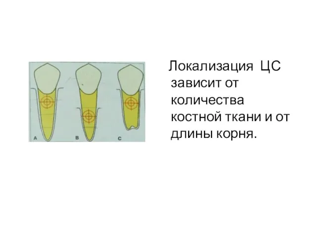 Локализация ЦС зависит от количества костной ткани и от длины корня.