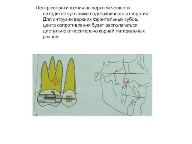 Центр сопротивления на верхней челюсти находится чуть ниже подглазничного отверстия. Для