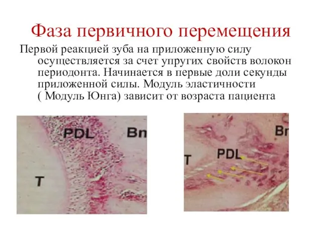 Фаза первичного перемещения Первой реакцией зуба на приложенную силу осуществляется за