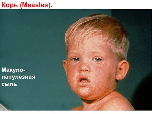 Корь (Measles). Макуло-папулезная сыпь