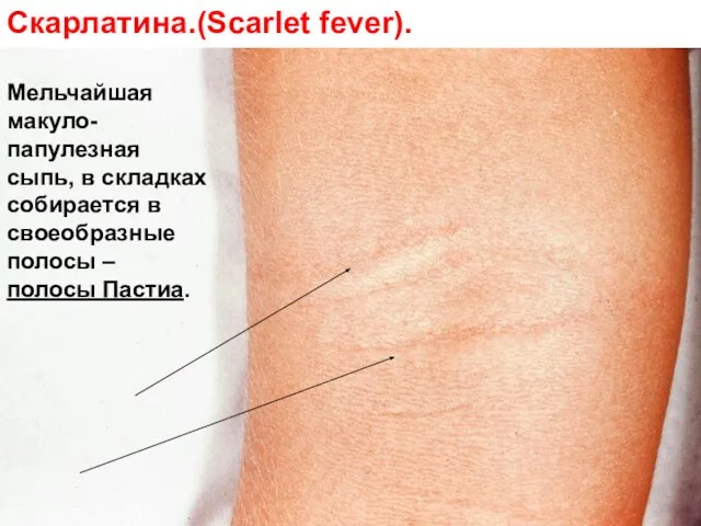 Скарлатина.(Scarlet fever). Мельчайшая макуло-папулезная сыпь, в складках собирается в своеобразные полосы – полосы Пастиа.