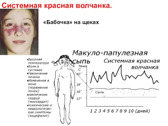 Системная красная волчанка. «Бабочка» на щеках