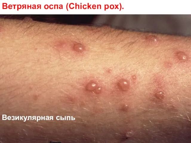 Ветряная оспа (Chicken pox). Везикулярная сыпь