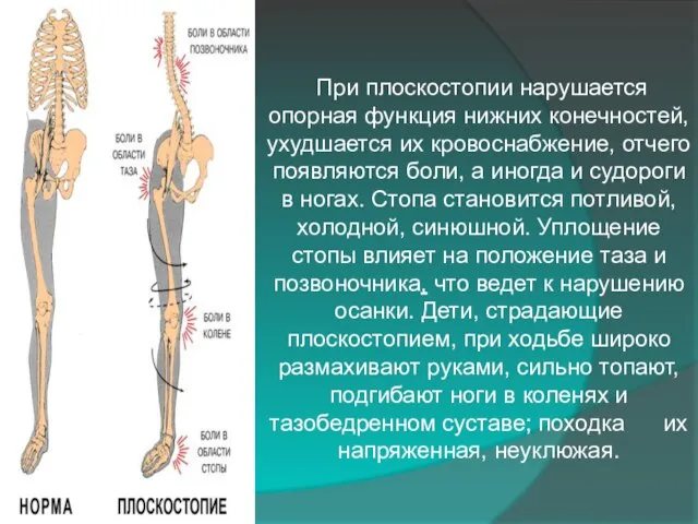 При плоскостопии нарушается опорная функция нижних конечностей, ухудшается их кровоснабжение, отчего