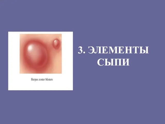 3. ЭЛЕМЕНТЫ СЫПИ