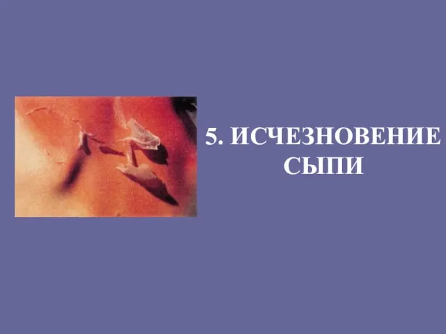 5. ИСЧЕЗНОВЕНИЕ СЫПИ