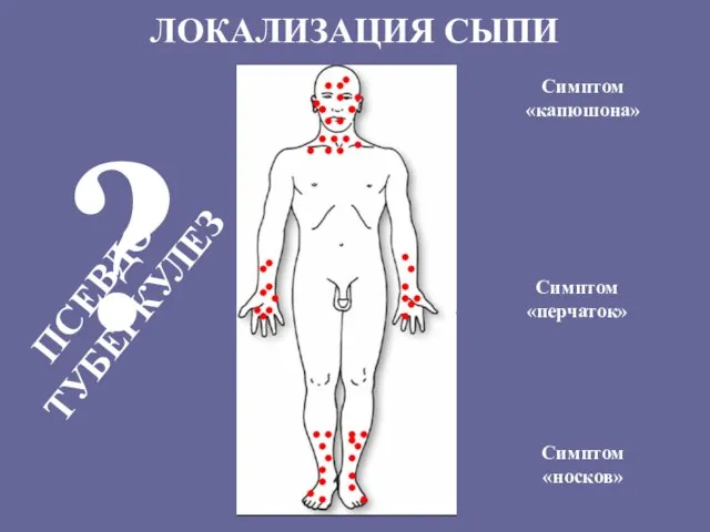 ЛОКАЛИЗАЦИЯ СЫПИ Симптом «перчаток» Симптом «носков» Симптом «капюшона» ? ПСЕВДО-ТУБЕРКУЛЕЗ