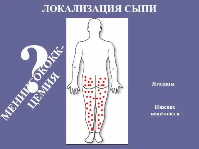 ЛОКАЛИЗАЦИЯ СЫПИ Ягодицы ? МЕНИНГОКОКК-ЦЕМИЯ Нижние конечности