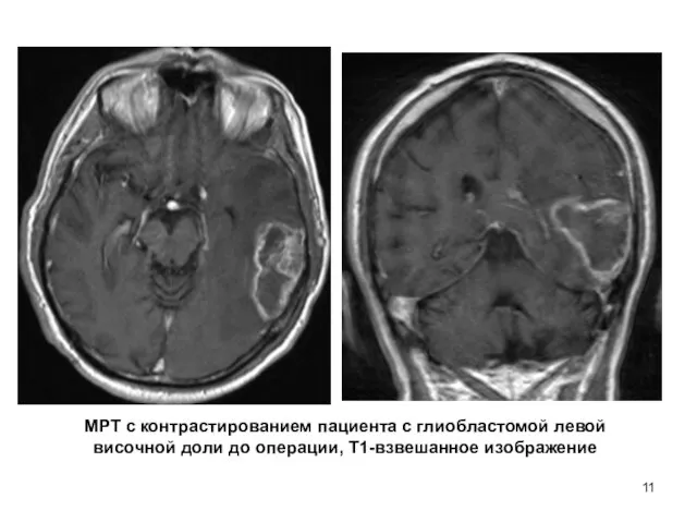МРТ с контрастированием пациента с глиобластомой левой височной доли до операции, Т1-взвешанное изображение