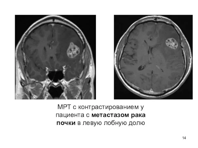 МРТ с контрастированием у пациента с метастазом рака почки в левую лобную долю