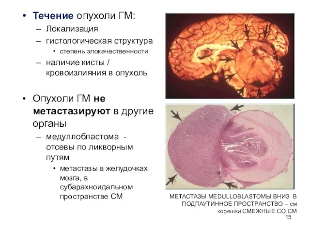 Течение опухоли ГМ: Локализация гистологическая структура степень злокачественности наличие кисты /