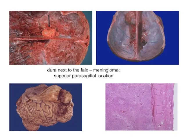 dura next to the falx – meningioma; superior parasagittal location