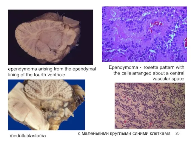 ependymoma arising from the ependymal lining of the fourth ventricle Ependymoma