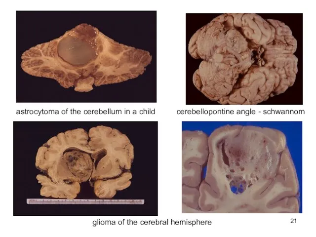 astrocytoma of the cerebellum in a child cerebellopontine angle - schwannom glioma of the cerebral hemisphere