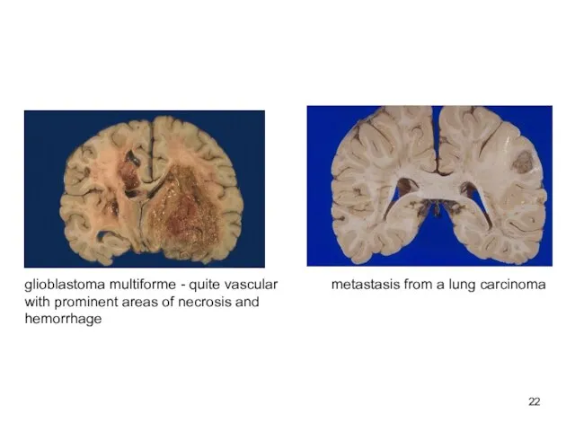 glioblastoma multiforme - quite vascular with prominent areas of necrosis and