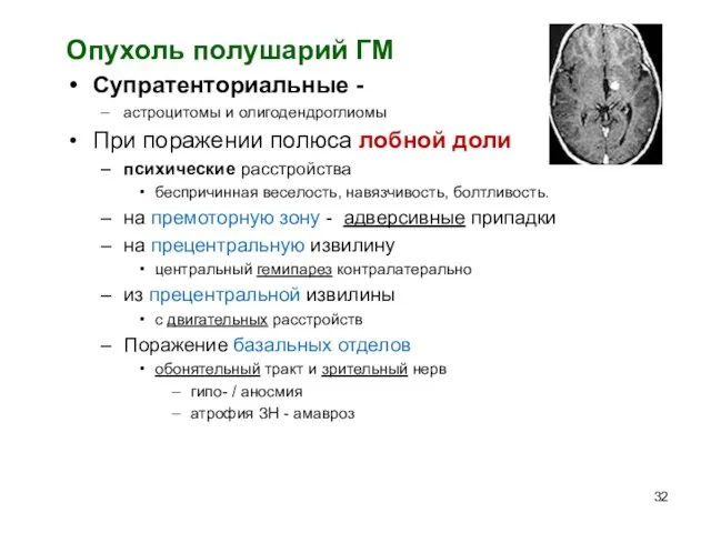 Опухоль полушарий ГМ Супратенториальные - астроцитомы и олигодендроглиомы При поражении полюса