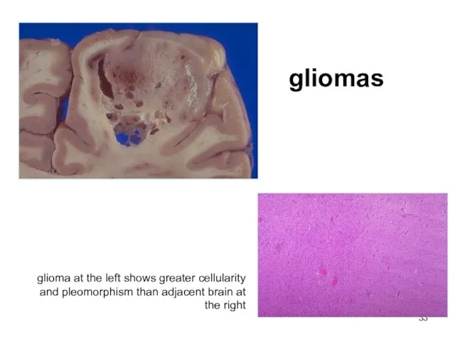 gliomas glioma at the left shows greater cellularity and pleomorphism than adjacent brain at the right