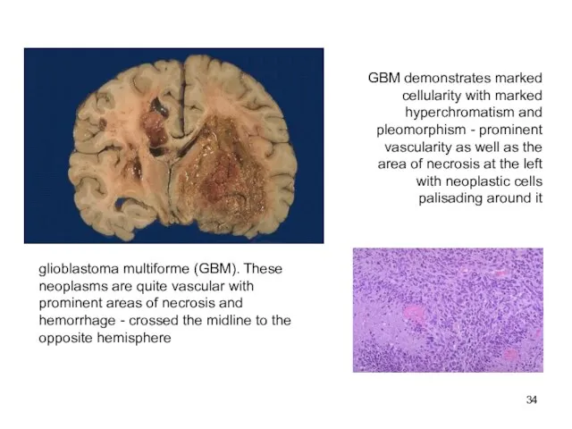 glioblastoma multiforme (GBM). These neoplasms are quite vascular with prominent areas