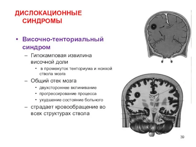 ДИСЛОКАЦИОННЫЕ СИНДРОМЫ Височно-тенториальный синдром Гипокамповая извилина височной доли в промежуток тенториума