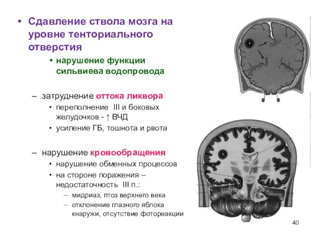 Сдавление ствола мозга на уровне тенториального отверстия нарушение функции сильвиева водопровода