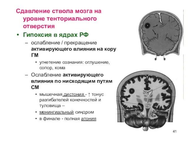 Сдавление ствола мозга на уровне тенториального отверстия Гипоксия в ядрах РФ