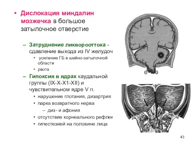 Дислокация миндалин мозжечка в большое затылочное отверстие Затруднение ликворооттока - сдавление