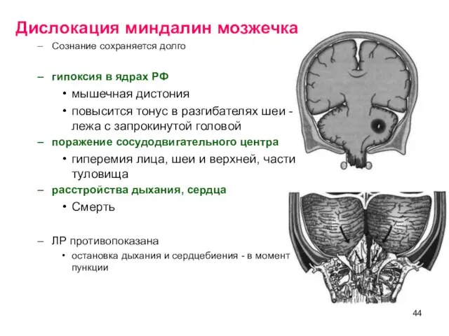 Дислокация миндалин мозжечка Сознание сохраняется долго гипоксия в ядрах РФ мышечная