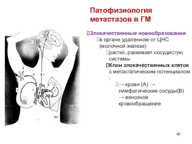 Патофизиология метастазов в ГМ Злокачественные новообразования в органе удаленном от ЦНС