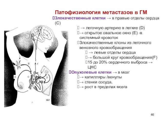 Патофизиология метастазов в ГМ Злокачественные клетки → в правые отделы сердца