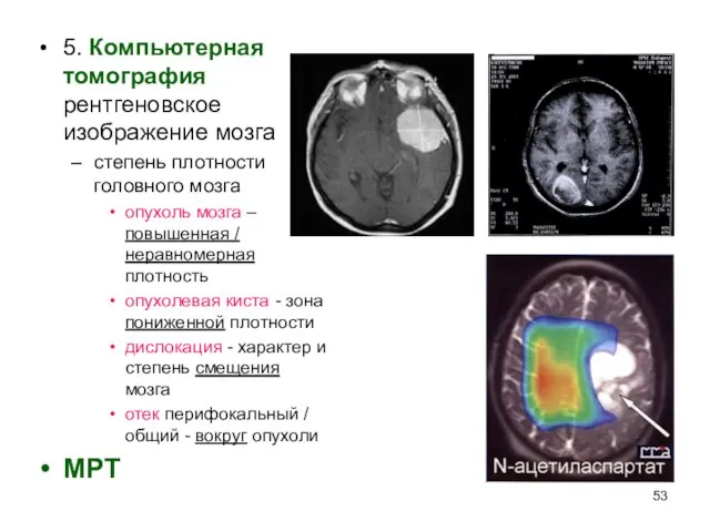5. Компьютерная томография рентгеновское изображение мозга степень плотности головного мозга опухоль