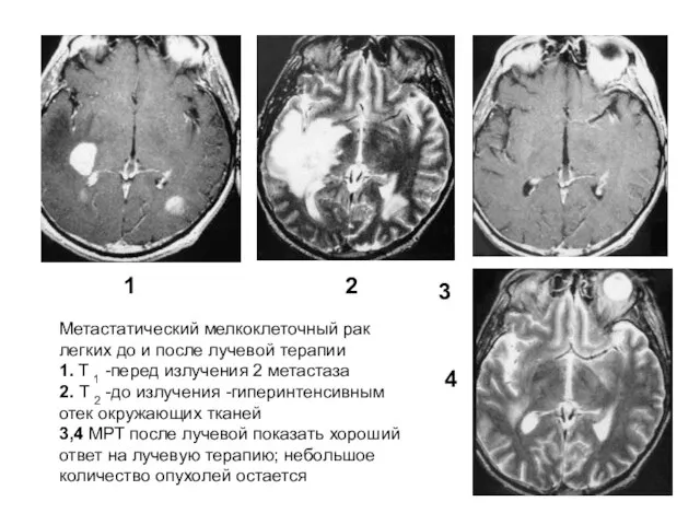 Метастатический мелкоклеточный рак легких до и после лучевой терапии 1. T