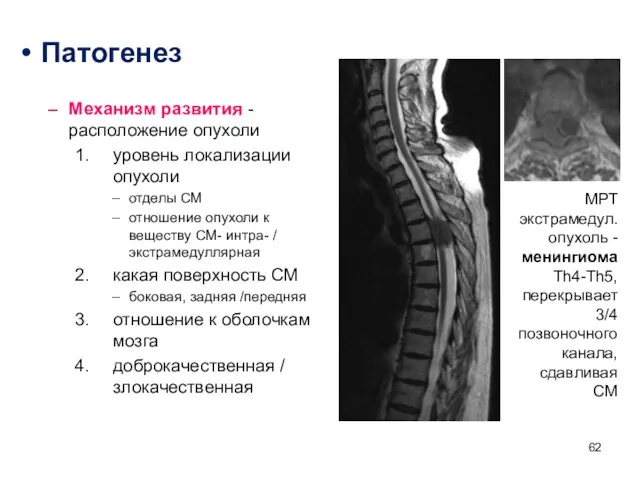 Патогенез Механизм развития - расположение опухоли уровень локализации опухоли отделы СМ