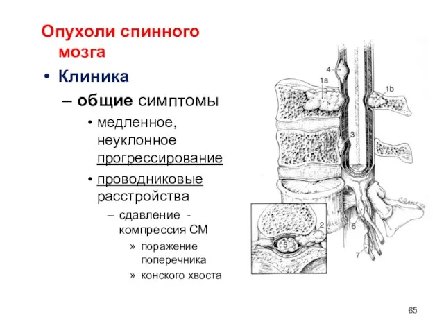 Опухоли спинного мозга Клиника общие симптомы медленное, неуклонное прогрессирование проводниковые расстройства