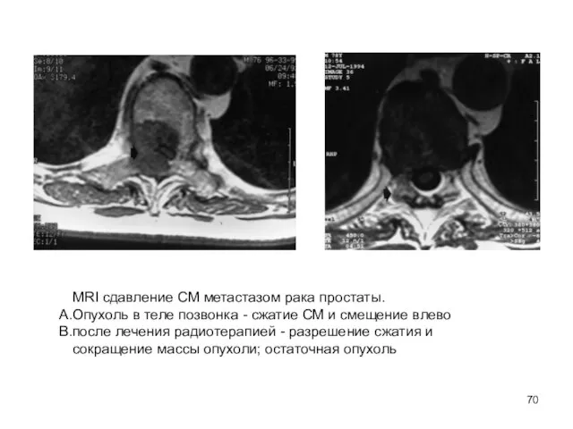 MRI сдавление СМ метастазом рака простаты. Опухоль в теле позвонка -