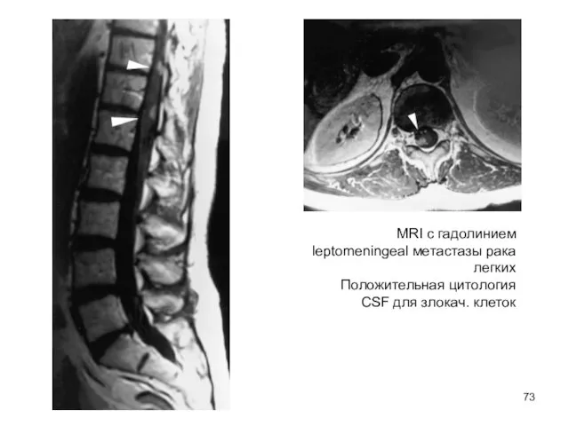 MRI с гадолинием leptomeningeal метастазы рака легких Положительная цитология CSF для злокач. клеток