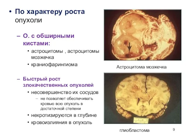 По характеру роста опухоли О. с обширными кистами: астроцитомы , астроцитомы