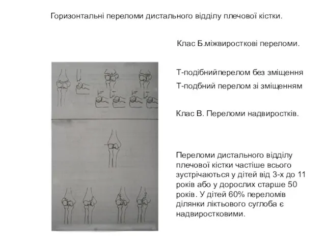 Горизонтальні переломи дистального відділу плечової кістки. Клас Б.міжвиросткові переломи. Т-подібнийперелом без