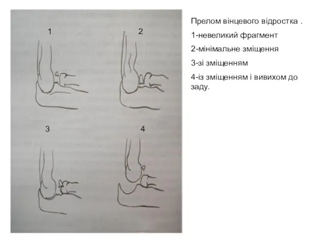 Прелом вінцевого відростка . 1-невеликий фрагмент 2-мінімальне зміщення 3-зі зміщенням 4-із