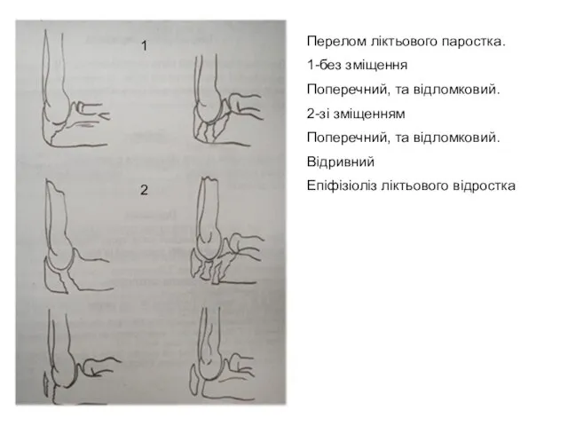 Перелом ліктьового паростка. 1-без зміщення Поперечний, та відломковий. 2-зі зміщенням Поперечний,