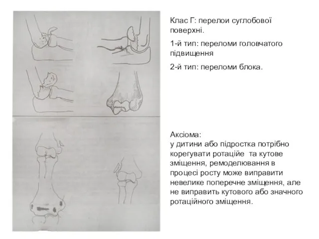 Клас Г: перелои суглобової поверхні. 1-й тип: переломи головчатого підвищення 2-й