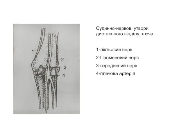 Судинно-нервові утвори дистального відділу плеча. 1-ліктьовий нерв 2-Променевий нерв 3-серединний нерв