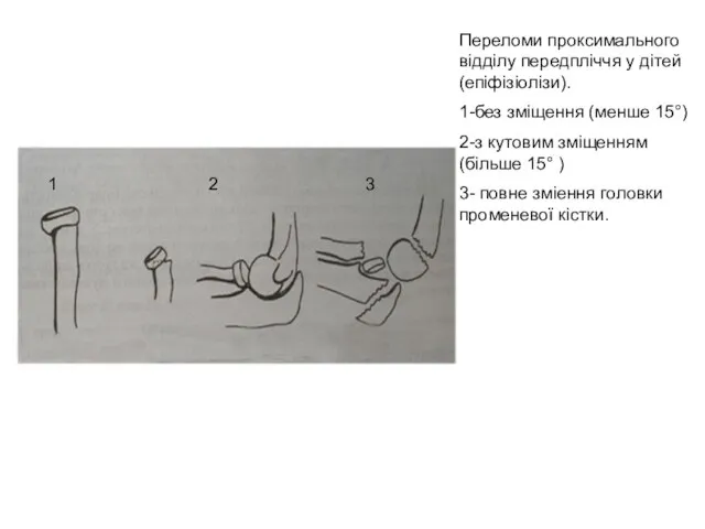 Переломи проксимального відділу передпліччя у дітей (епіфізіолізи). 1-без зміщення (менше 15°)