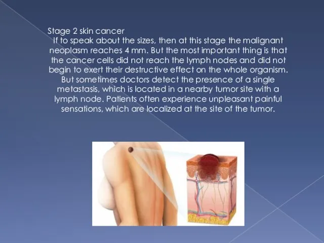Stage 2 skin cancer If to speak about the sizes, then