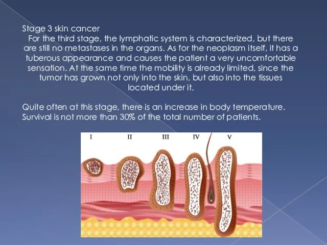 Stage 3 skin cancer For the third stage, the lymphatic system