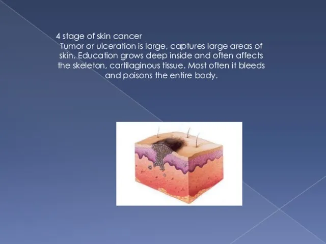 4 stage of skin cancer Tumor or ulceration is large, captures