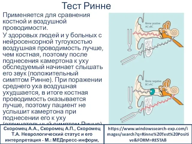 Тест Ринне Применяется для сравнения костной и воздушной проводимости. У здоровых