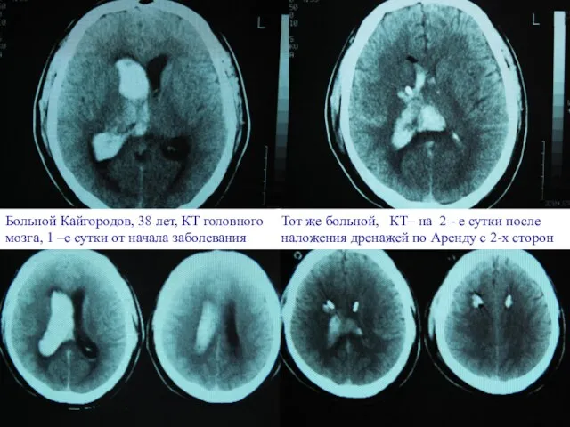 Больной Кайгородов, 38 лет, КТ головного мозга, 1 –е сутки от